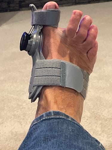 I wish I had a before photo of my feet to show just how amazing these bunion correctors have been!! I'm not sure when it started but I played sports for years and ballet and never found something to help until I found this. The little adjuster knobs and two-sided velcro sides really help advance your progress over time. It's only been two months and the joints are almost straight!