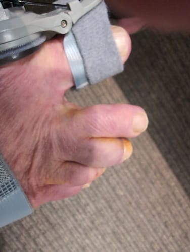 The bunion corrector is definitely working and I hope to avoid surgery altogether