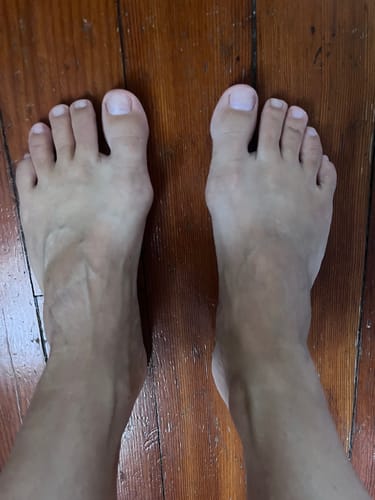 My foot particularly the right is alway painful when walking long distances, but since I use the orthopaedic bunion sleeves I don't have the pain anymore.  Thank you Treatmedy.